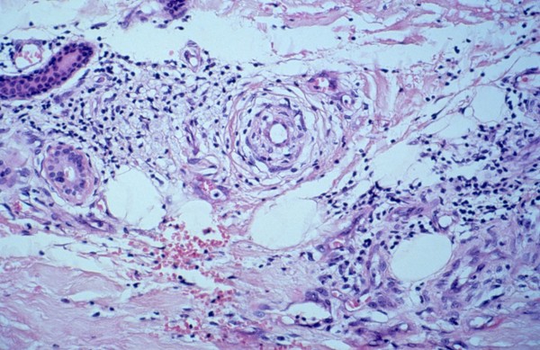 Diffuse lepromatous leprosy: Lucio phenomenon