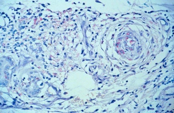 Diffuse lepromatous leprosy: Lucio phenomenon