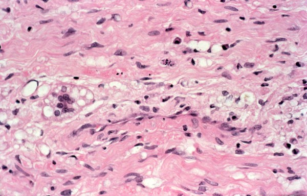 Lepromatous leprosy: type 2 ENL reaction