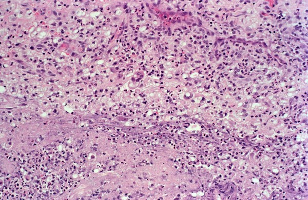 Lepromatous leprosy: type 2 ENL reaction