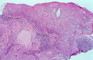 view Conjunctiva: in situ carcinoma with HIV