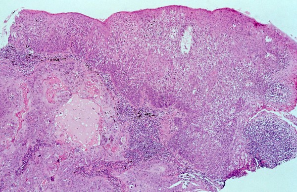 Conjunctiva: in situ carcinoma with HIV