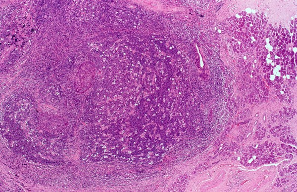 Parotid gland: lymphoepithelial cyst with HIV