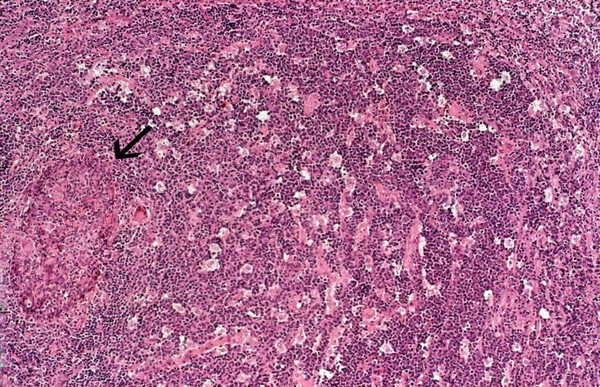 Parotid gland: lymphoepithelial cyst with HIV