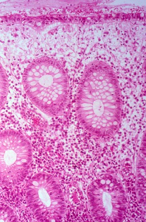 view Amoebiasis: histopathology of the colon