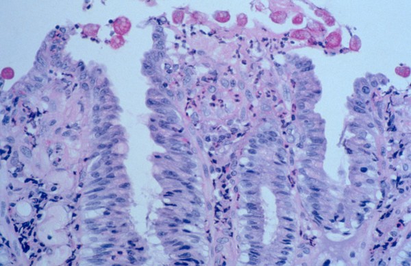 Amoebiasis: histopathology of the colon
