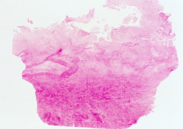 Amoebiasis: amoebic abscess in liver