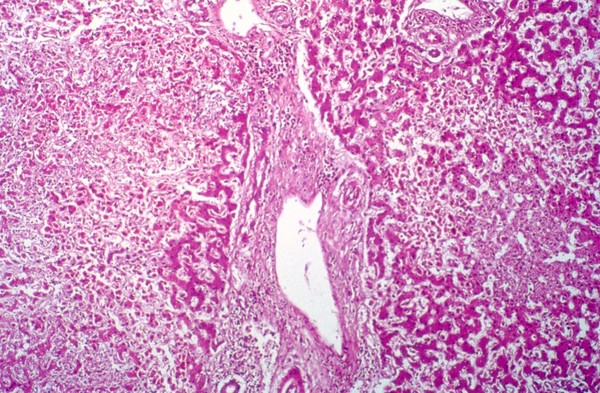 Amoebiasis: amoebic abscess in liver