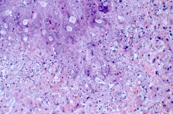 Amoebiasis: amoebic abscess in liver
