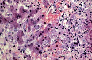 view Amoebiasis: amoebic abscess in liver