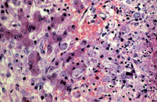 Amoebiasis: amoebic abscess in liver