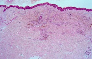 view Kaposi's sarcoma with HIV