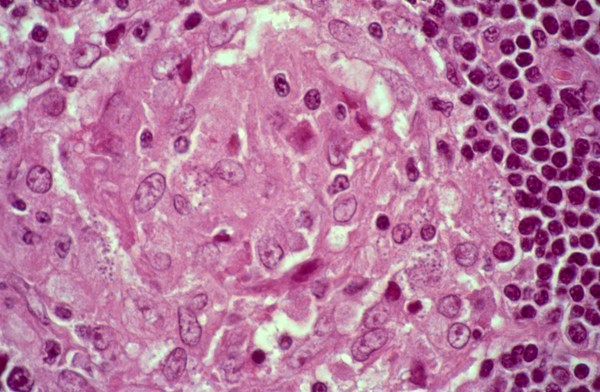Visceral leishmaniasis: lymph node