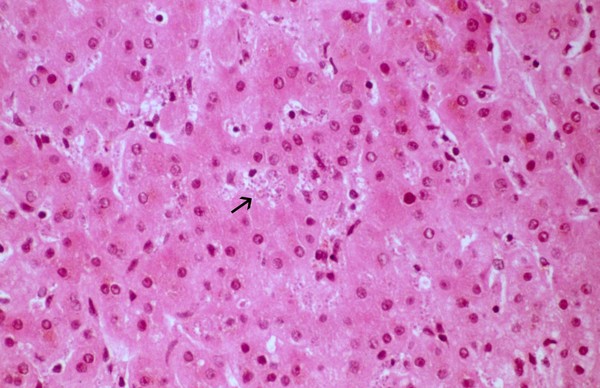 Visceral leishmaniasis: liver