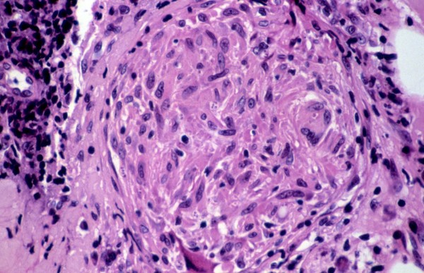 Cutaneous leishmaniasis: skin lesion