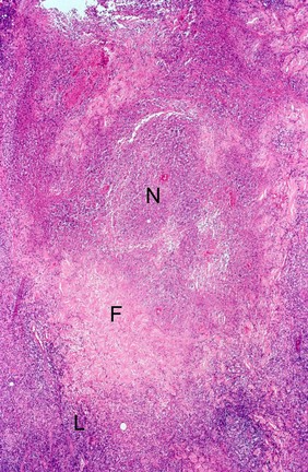 Cutaneous leishmaniasis: skin lesion