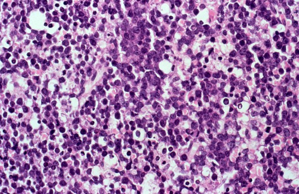 Non-Hodgkin's lymphoma with AIDS: bone marrow