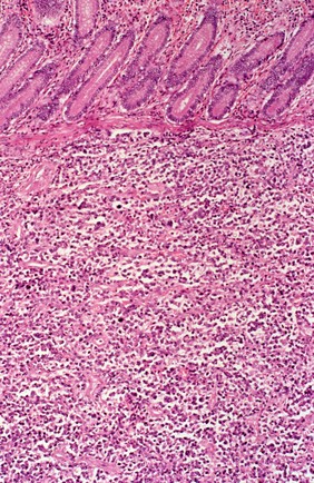 Lymphoma with HIV: colon