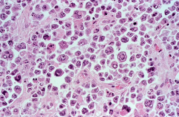 Lymphoma with HIV: colon