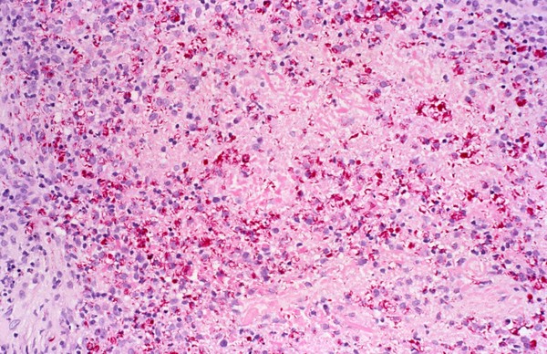 Lepromatous leprosy): local (acute) exacerbation reaction