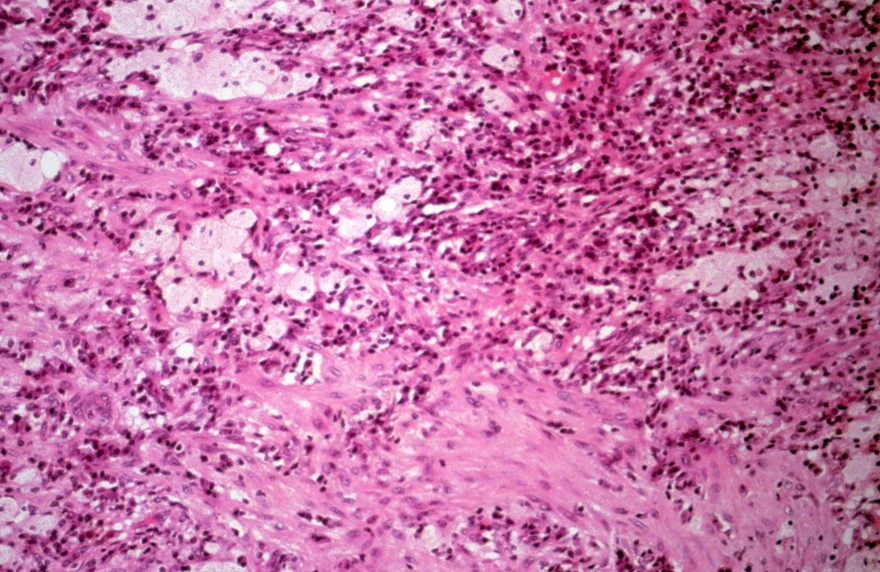 Donovanosis (granuloma inguinale): skin lesion