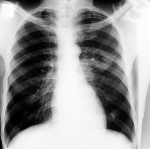 view Primary pulmonary TB: plain chest x-ray