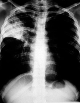 Tuberculosis