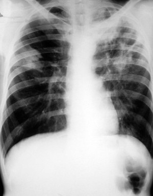 view Pulmonary tuberculosis