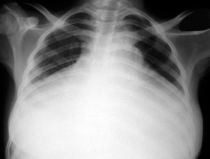 view Tuberculous pericarditis and HIV