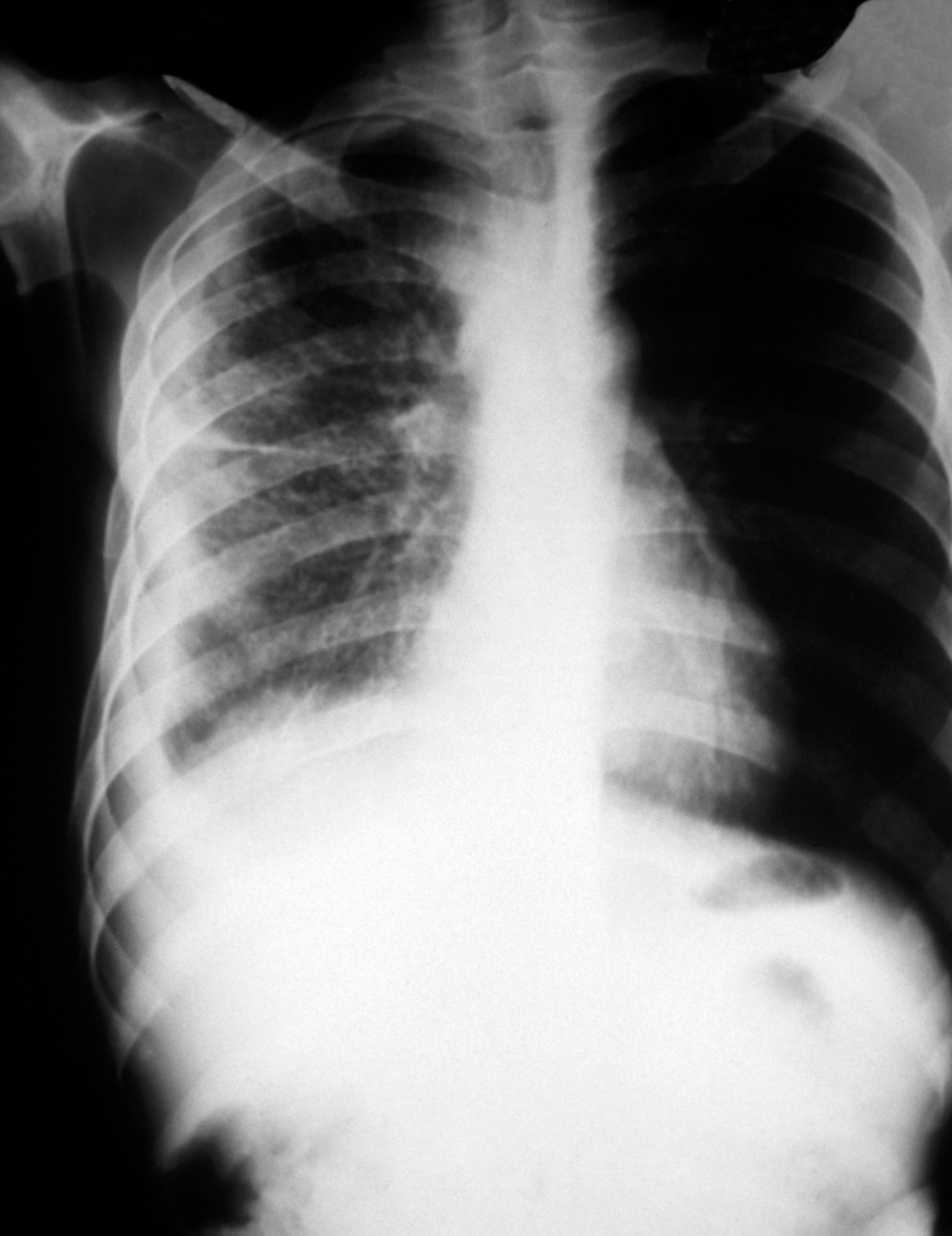 Get Wallpaper Pulmonary Tb Plain Chest X Ray Wellcome Collection For Android Free