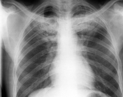 Pulmonary TB: plain chest x-ray 