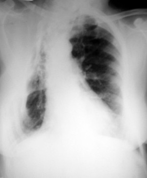 view Pulmonary TB: plain chest x-ray