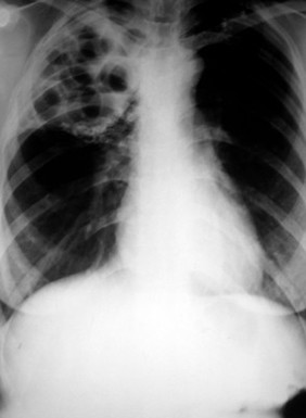 Miliary TB: plain chest x-ray