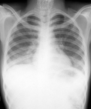 view Tuberculosis and HIV