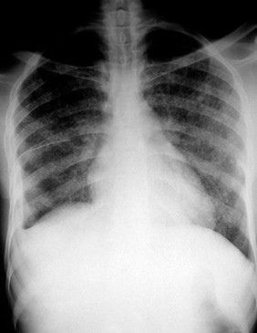 Miliary tuberculosis and HIV