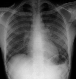 Pneumocystis carinii pneumonia