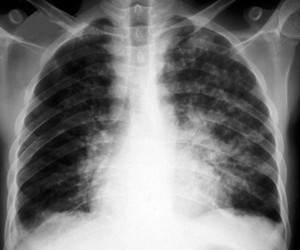 view Kaposi's sarcoma and Pneumocystis carinii pneumonia