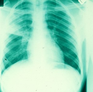 view Bacterial pneumonia