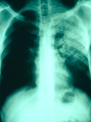 view Streptococcal pneumonia