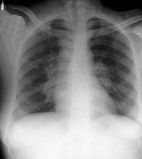 Nocardia pneumonia