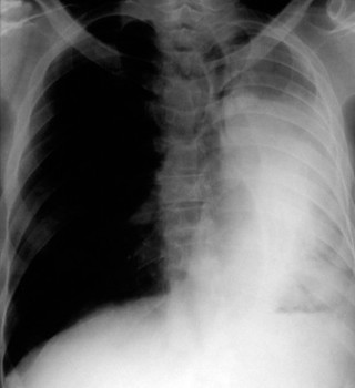 Carcinoma of the lung: plain chest x-ray