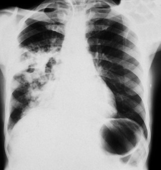 Pulmonary TB: plain chest x-ray