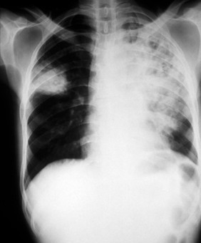 Klebsiella pneumonia