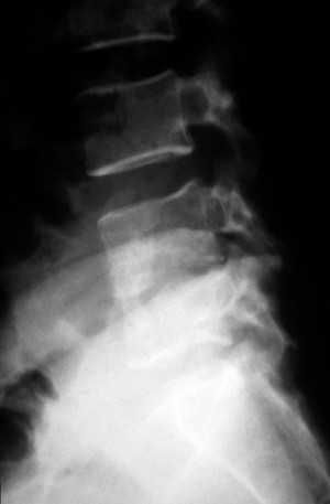 view TB of the lumbar spine: lateral x-ray of the spine