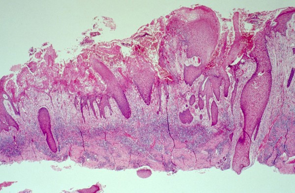 Amoebiasis: Histopathology of the skin