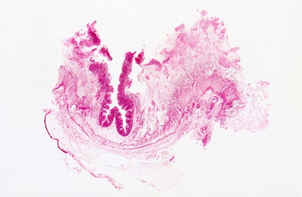 Amoebiasis: colon