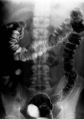 Schistosomiasis: digestive system lesions