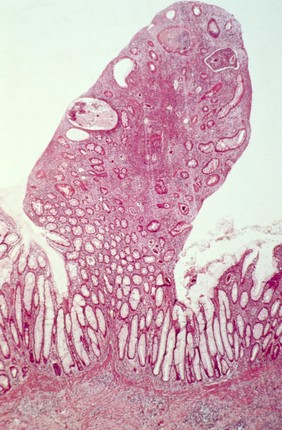 Schistosomiasis: large intestine