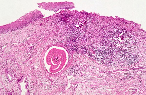 Schistosomiasis: vulva