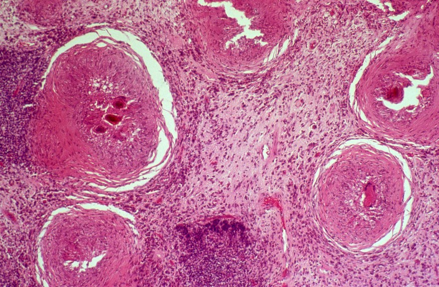 Schistosomiasis: urinary bladder